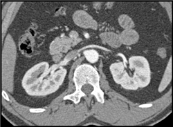 Stent in SMA Aneurysm - CTisus CT Scan