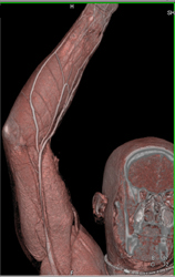 Av Shunt in Right Axilla With Collaterals - CTisus CT Scan