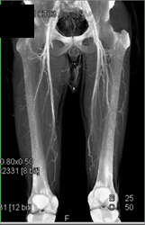 Pelvic Congestion Syndrome - CTisus CT Scan