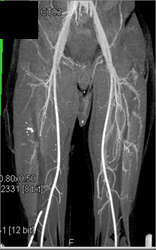 Superficial Femoral Artery (SFA) Disease - CTisus CT Scan