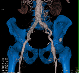 Stenosis of the Right Pulmonary Artery - CTisus CT Scan