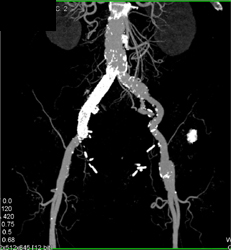 Cancer of the Pancreas Encases PV/SMV Junction - CTisus CT Scan