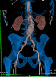 Aortic Dissection - CTisus CT Scan