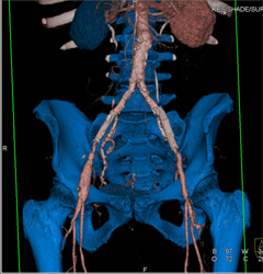 Descending Aortic Aneurysm - CTisus CT Scan