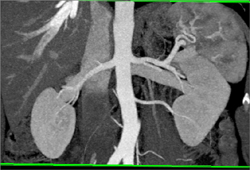 Pseudocysts Compress the Splenic Vein With Extensive Varices - CTisus CT Scan