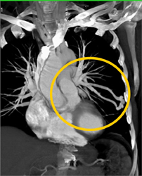 Endovascular Stent - CTisus CT Scan