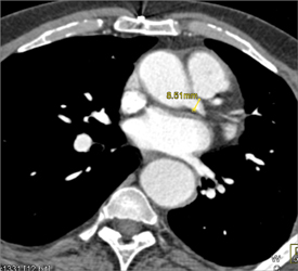 Hepatic and Splenic Artery Directly Off Aorta - CTisus CT Scan