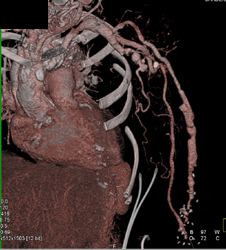 Renal Artery Aneurysm Shown With Various Renderings - CTisus CT Scan