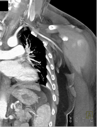 Hypervascular Renal Cell Carcinoma With Renal and IVC Vein Extension - CTisus CT Scan