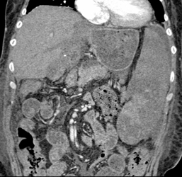 Patent Bypass Grafts - CTisus CT Scan