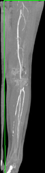 Patent Bypass Grafts - CTisus CT Scan