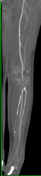 Patent Bypass Grafts - CTisus CT Scan