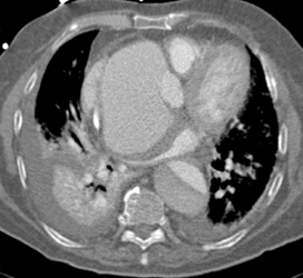 Patent Bypass Grafts - CTisus CT Scan