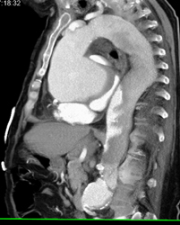 Patent Left Internal Mammary Artery (LIMA) Graft - CTisus CT Scan