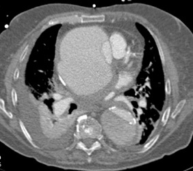 Patent Left Internal Mammary Artery (LIMA) Graft - CTisus CT Scan