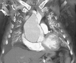 Patent Left Internal Mammary Artery (LIMA) Graft - CTisus CT Scan