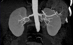 Occluded Left Common Iliac Artery - CTisus CT Scan