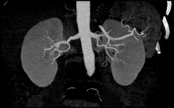 Multiple Renal Arteries - CTisus CT Scan