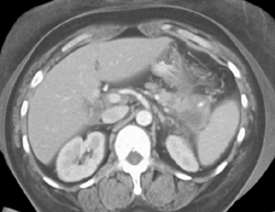 Stenosis of Celiac Arteries - CTisus CT Scan