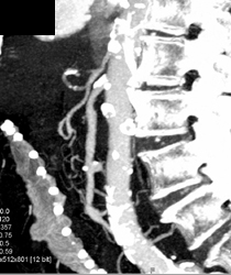 Prominent Thymus But Normal Arch Vessels - CTisus CT Scan