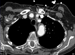 Occlusion of Left Common Iliac Artery With Demonstration of Bone Removal - CTisus CT Scan