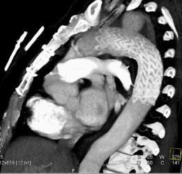 Nice IVC Opacification of Renal Veins - CTisus CT Scan