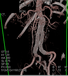 1 Mm Accessory Renal Artery in Donor - CTisus CT Scan