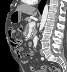 Renal Artery Aneurysm in Multiple Views - CTisus CT Scan