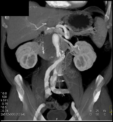 CTA of Arm With Nice Mapping - CTisus CT Scan