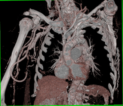 Ulceration W/o Abscess - CTisus CT Scan