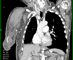 GSW in Thigh Without Bleed - CTisus CT Scan