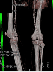 Stab Wound to Axilla Without Vascular Injury - CTisus CT Scan