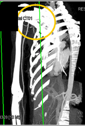 Normal Pancreas and SMA/celiac Relationship - CTisus CT Scan