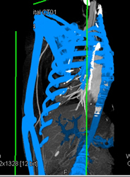 Normal Brachial Artery - CTisus CT Scan