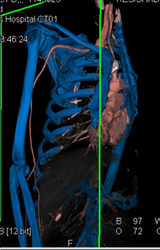 Stent in Right Common Iliac Artery That Is Patent With Range of Display Techniques - CTisus CT Scan