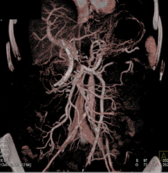 Abdominal Aortic Aneurysm (AAA) With Bone Removal - CTisus CT Scan