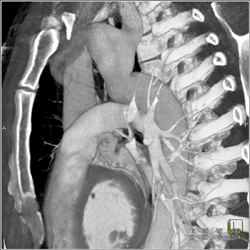 Loeys-Dietz Carotids - CTisus CT Scan