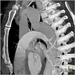 Stent in Right Carotid Artery - CTisus CT Scan