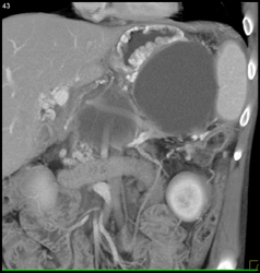 Adrenal Vein - CTisus CT Scan