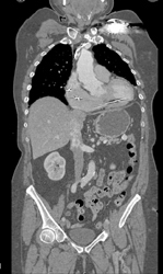 GSW Knee With Vascular Injury - CTisus CT Scan