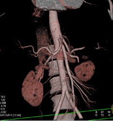 Left Main Coronary Aneurysm - CTisus CT Scan