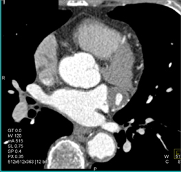 Left Circumflex Coronary Artery Aneurysm - CTisus CT Scan