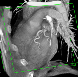 Normal LAD - CTisus CT Scan