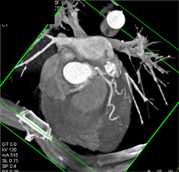 Right Coronary Arises Off the Left Cusp - CTisus CT Scan