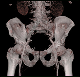 Iliac Artery Aneurysm With Stents - CTisus CT Scan