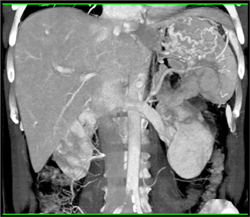 Occluded Splenic Vein With Gastric Varices - CTisus CT Scan