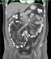 Mesenteric Panniculitis - CTisus CT Scan