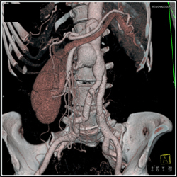 Loeys-Dietz With SMA, Celiac, and IMA Aneurysms - CTisus CT Scan