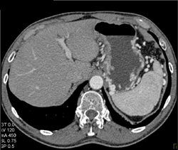 Islet Cell Tumor Occludes the Splenic Vein With Large Varices - CTisus CT Scan