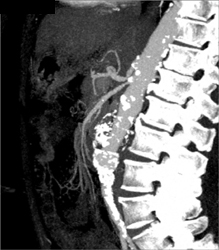 Celiac and SMA Arise From A Common Trunk - CTisus CT Scan